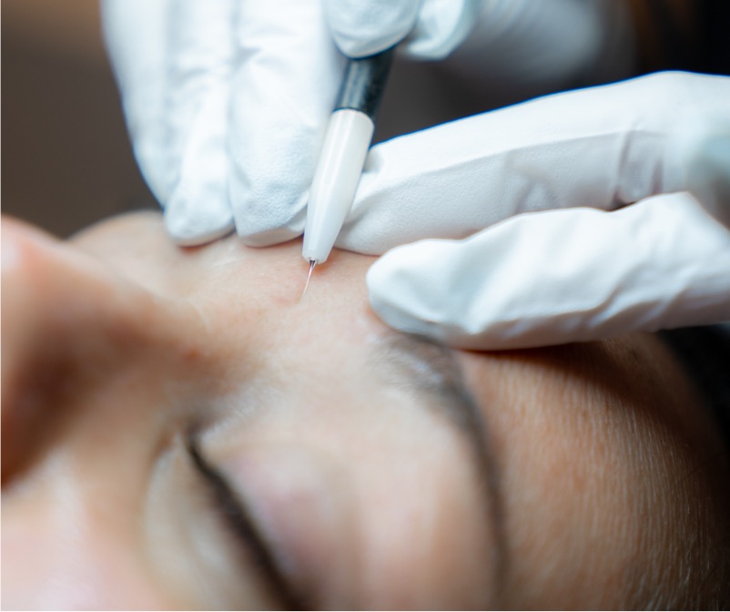 Épilation définitive par électrolyse | Style en Tête